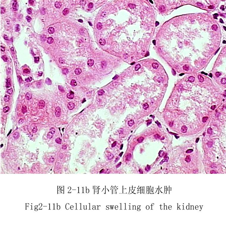 腎小管上皮細胞水腫